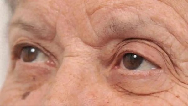 眼睛是胰腺癌的“预警器”？提醒：出现这3种变化，尽快去检查
